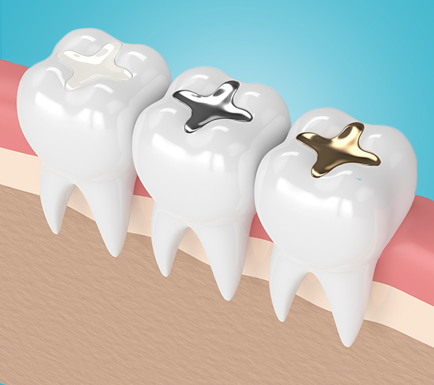 Grand Junction Composite Fillings