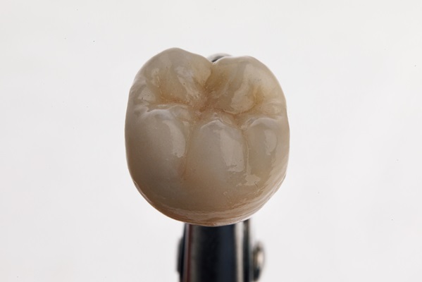 Is There A Recovery Period After Getting Dental Crowns?