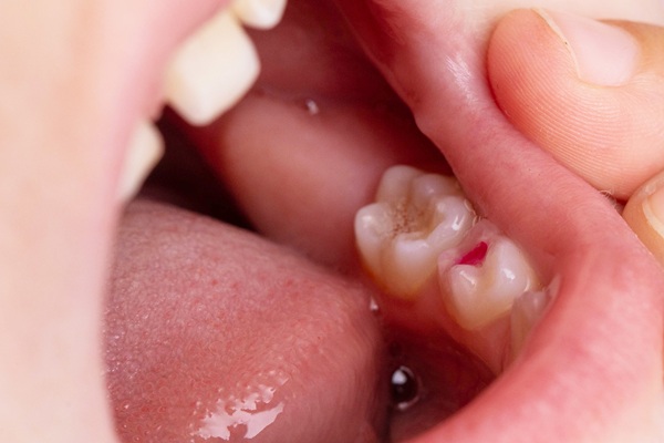 Signs That You May Have A Worn Dental Filling