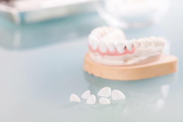 Guidelines To Know If You Are A Candidate For Dental Veneers