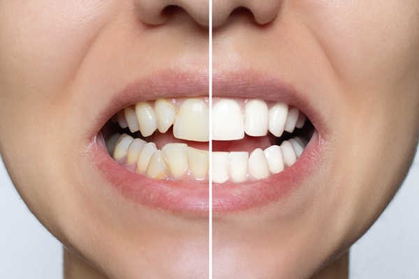 Teeth Whitening And Your Smile Makeover